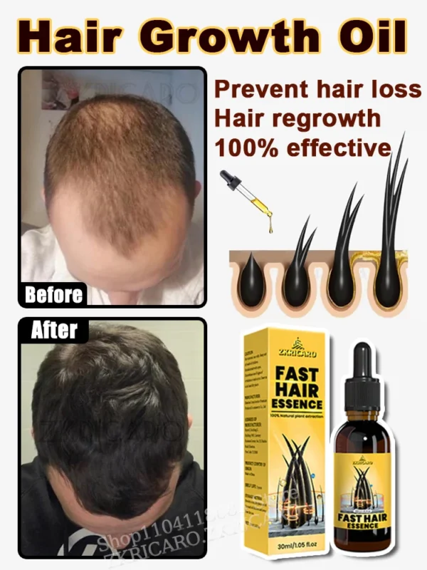 2025 Hair growth oil, repair baldness, hairline, seborrheic alopecia, rapid hair growth